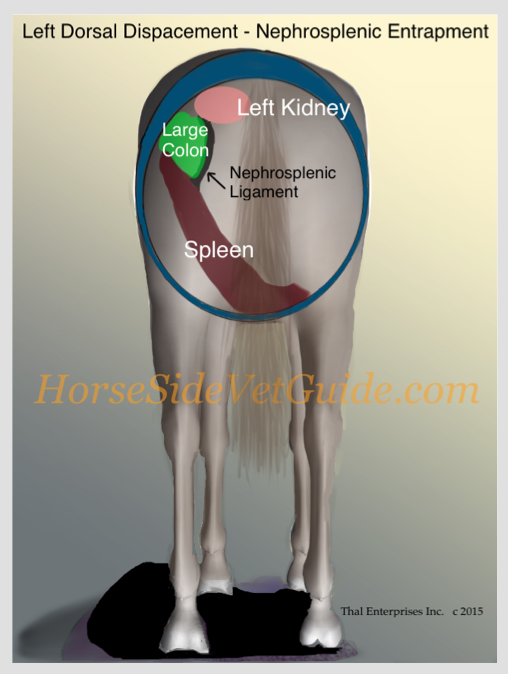 LDD with full nephrosplenic entrapment bordered