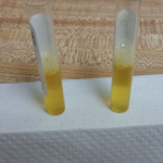 Cloudy Peritoneal Fluid from Belly Tap