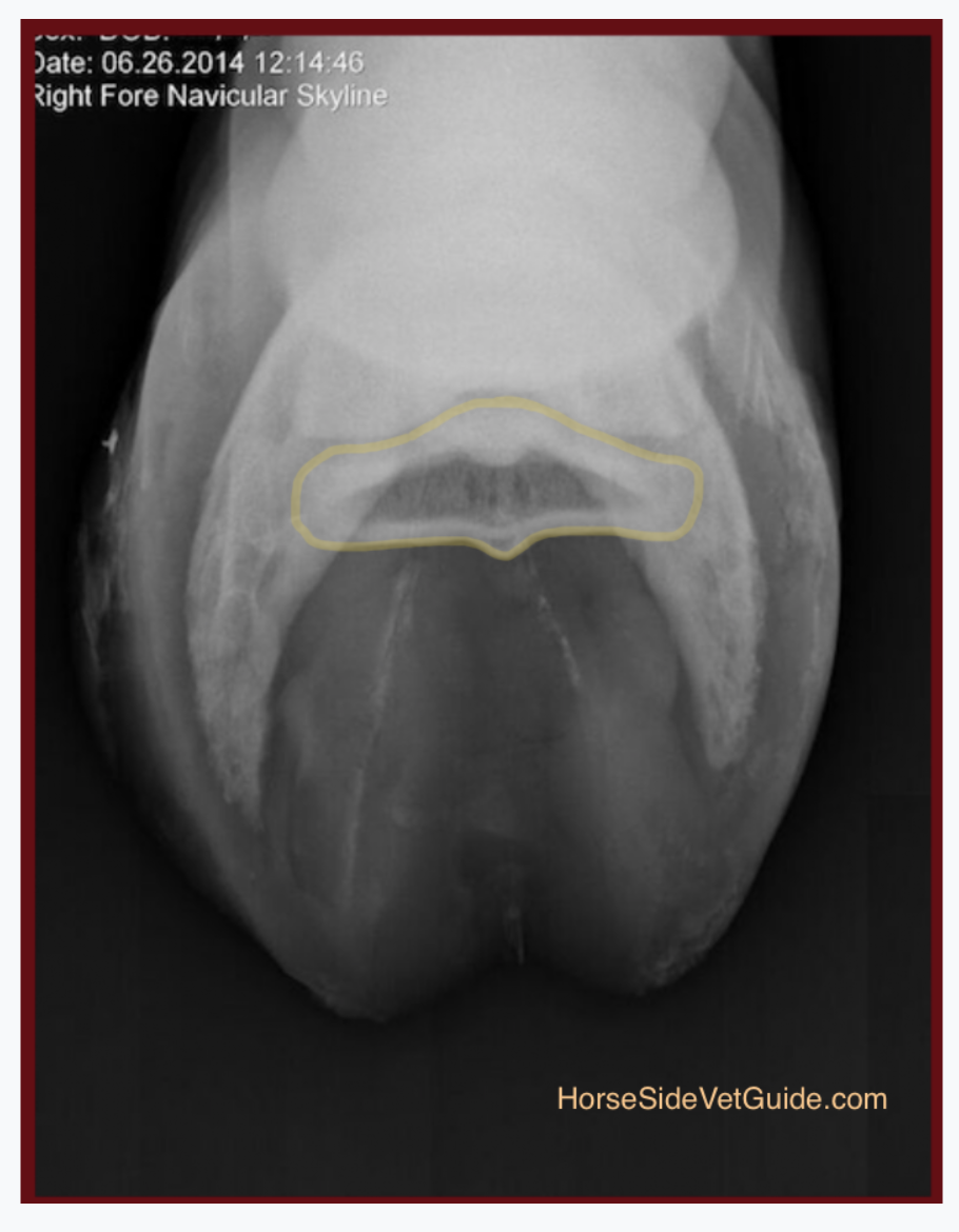 Looking at the bones of the hoof from about the 8:00 position. Yellow - Navicular bone. The DDFT and bursa are removed. Adapted from the Glass Horse Distal Limb.