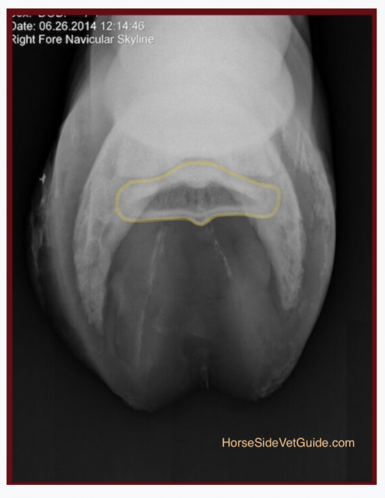 The Navicular Skyline radiograph taken looking down between the heels. This is an appearance of a normal bone.