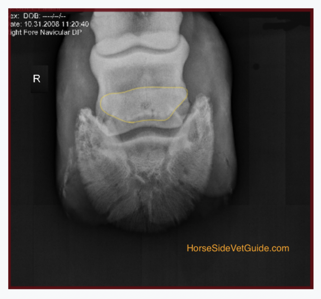 A view of an abnormal navicular bone from above. The navicular bone is outlined in yellow and shows a dark "hole" in the center, which corresponds to a small cyst in the bone.