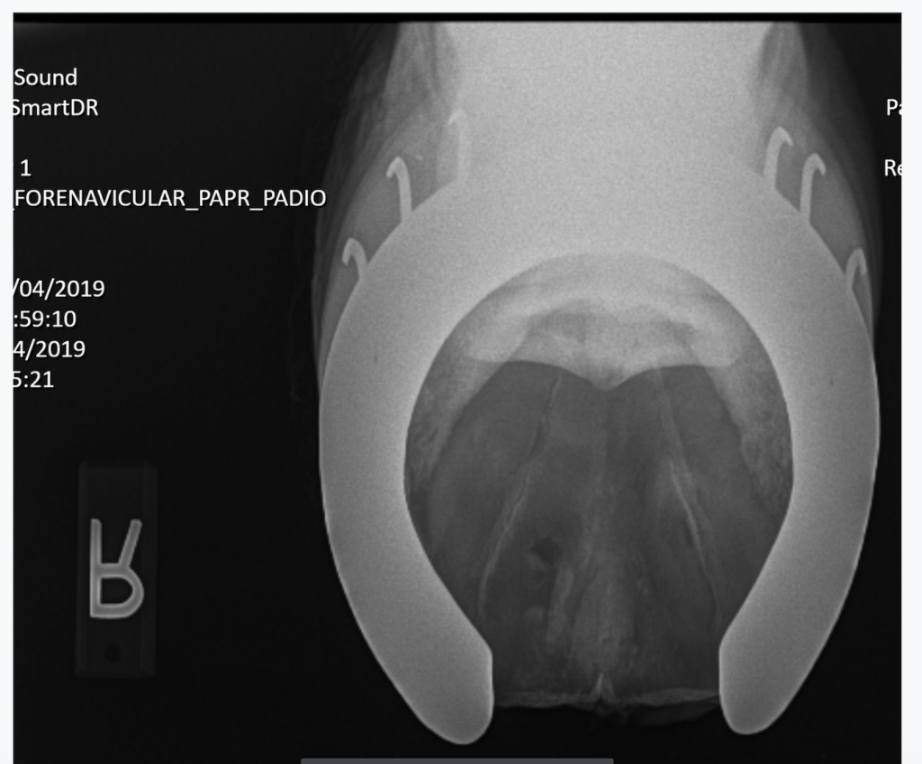 An example of a navicular skyline radiograph in which there is an erosion through the rear part of the bone- a bad abnormality to find, and a tough case to treat. In contrast to prior normal image.
