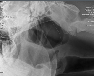 Look closely at this radiograph. The answer lies here. 